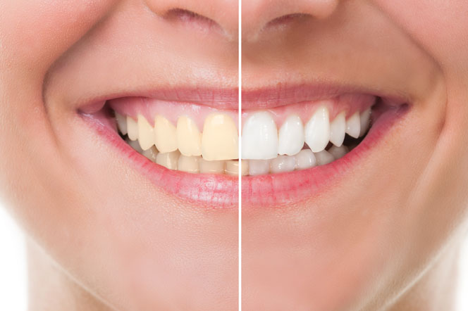 Teeth Whitening Procedures
